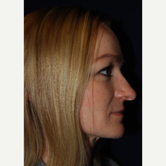 25-34 year old woman treated with Nose Surgery before 3093470