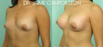 Breast Augmentation before 629470