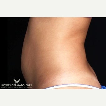 25-34 year old woman treated with UltraShape after 1801138
