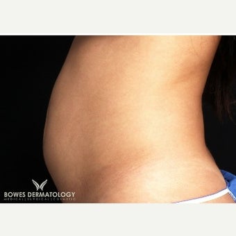 25-34 year old woman treated with UltraShape before 1801138