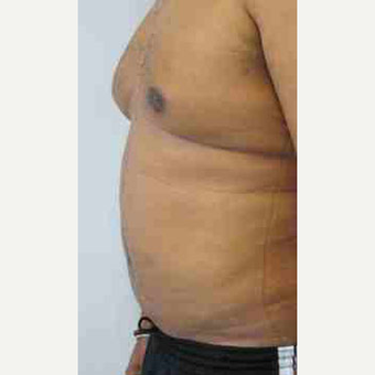 Male Breast Reduction after 3099948