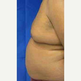 Male Breast Reduction before 3099948