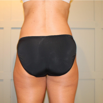 35-44 year old woman treated with CoolSculpting after 3069573
