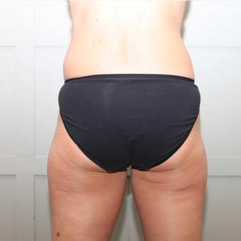 35-44 year old woman treated with CoolSculpting before 3069573