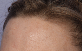 Limelight IPL to Forehead after 308350