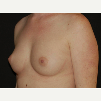 25-34 year old woman treated with Breast Implants before 3650989