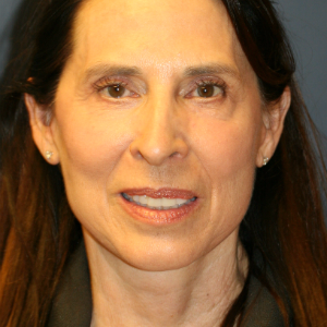 64 year old woman treated with Neck Lift after 3554104