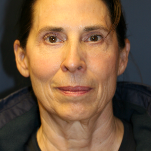 64 year old woman treated with Neck Lift before 3554104