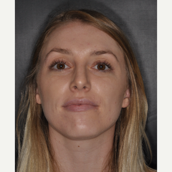 18-24 year old woman treated with Rhinoplasty 1 year post-op after 3499759