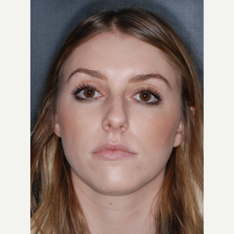 18-24 year old woman treated with Rhinoplasty 1 year post-op before 3499759