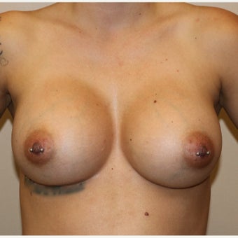 25-34 year old woman treated with Breast Augmentation after 2622729