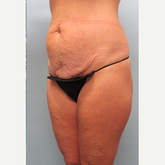 45 year old woman treated with Tummy Tuck before 3680096