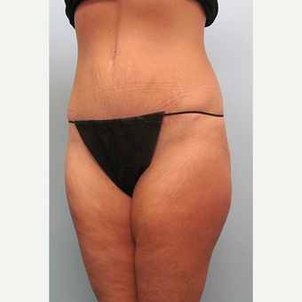 45 year old woman treated with Tummy Tuck after 3680096