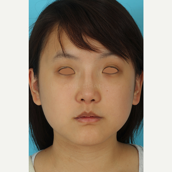 25-34 year old woman treated with Rhinoplasty after 3629053
