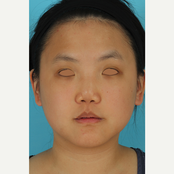 25-34 year old woman treated with Rhinoplasty before 3629053