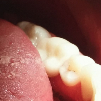Replacing old fillings to improve Smile after 3136484