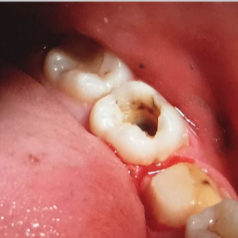 Replacing old fillings to improve Smile before 3136484