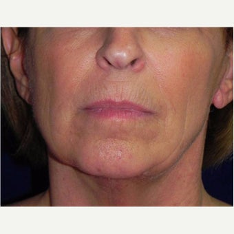 65-74 year old woman treated with ThermiTight after 2357745