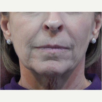 65-74 year old woman treated with ThermiTight before 2357745