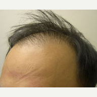 36 year old man treated with Hair Loss Treatment before 3815461