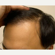 36 year old man treated with Hair Loss Treatment after 3815461