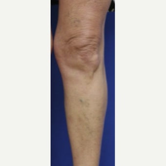 55-64 year old woman treated with Sclerotherapy before 2036995