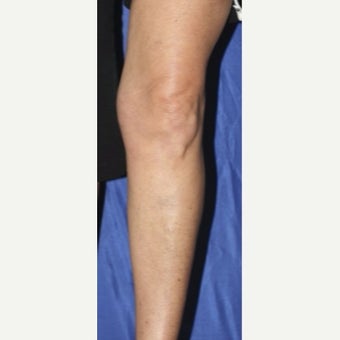 55-64 year old woman treated with Sclerotherapy after 2036995