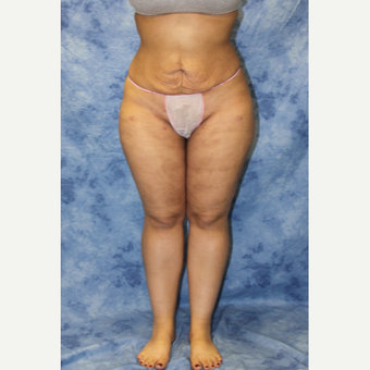 25-34 year old woman treated with Liposuction after 3330499
