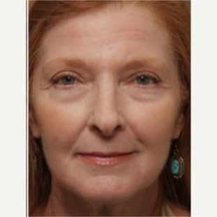 55-64 year old woman treated with Chemical Peel after 2344889