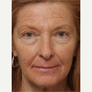 55-64 year old woman treated with Chemical Peel before 2344889