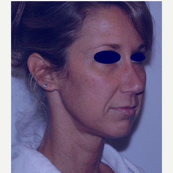 Rhinoplasty after 3324558