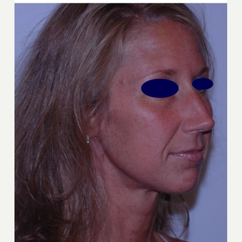 Rhinoplasty before 3324558