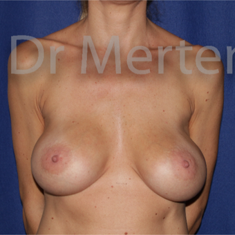 35-44 year old woman treated with Breast Lift with Implants before 3676015