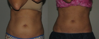 Female patient treated with CoolSculpting before 1114188