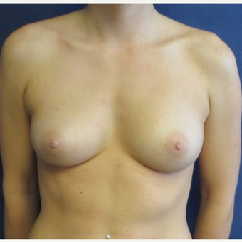 18-24 year old woman treated with Breast Augmentation before 3742978