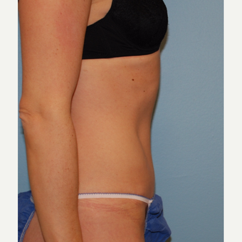 38 year old mother of 3 treated with Tummy Tuck after 3220183