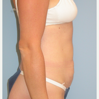 38 year old mother of 3 treated with Tummy Tuck before 3220183