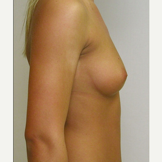Breast Implants before 3241538
