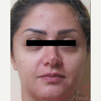 35-44 year old woman treated with Belotero before 3835929