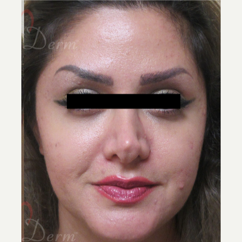35-44 year old woman treated with Belotero after 3835929