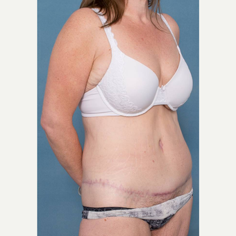 45-54 year old woman treated with Body Lift after 3442430
