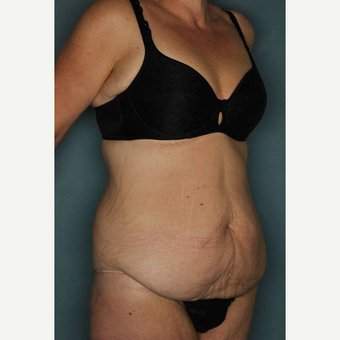 45-54 year old woman treated with Body Lift before 3442430