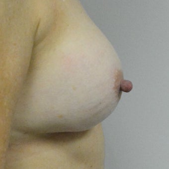 45-54 year old woman treated with Nipple reduction Surgery before 2507742