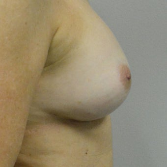45-54 year old woman treated with Nipple reduction Surgery after 2507742