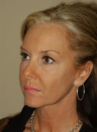 RefresherLift w/BrowLift and Fat Micrografting before 178002