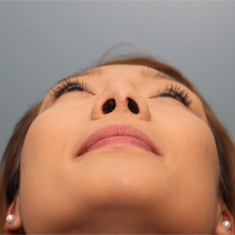 24 year old woman treated with Nose Surgery after 3544455