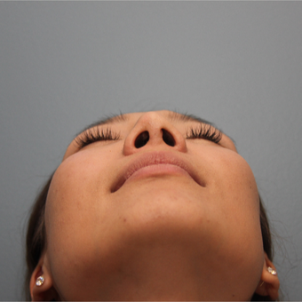 24 year old woman treated with Nose Surgery before 3544455