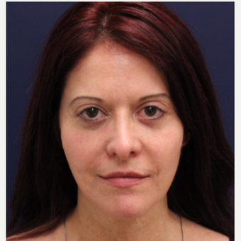 35-44 year old woman treated with Bellafill after 3142676