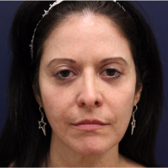 35-44 year old woman treated with Bellafill before 3142676