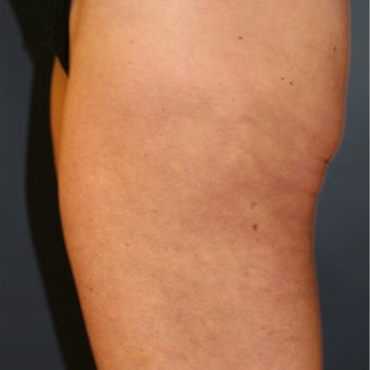 50 year old woman before and 8 mos. after ThermiTight of thighs for cellulite and loose skin after 2514569